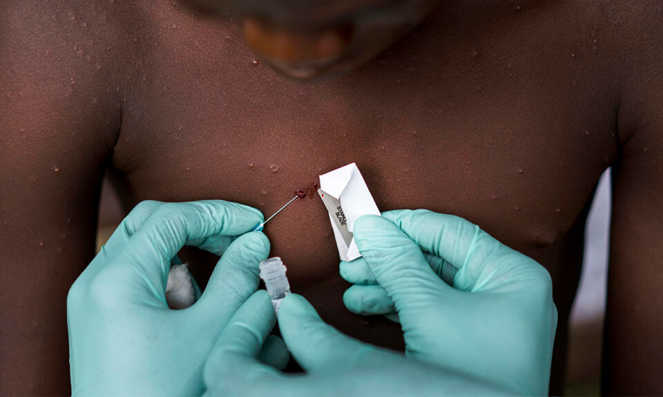 monkeypox examination africa header 1024x575 1